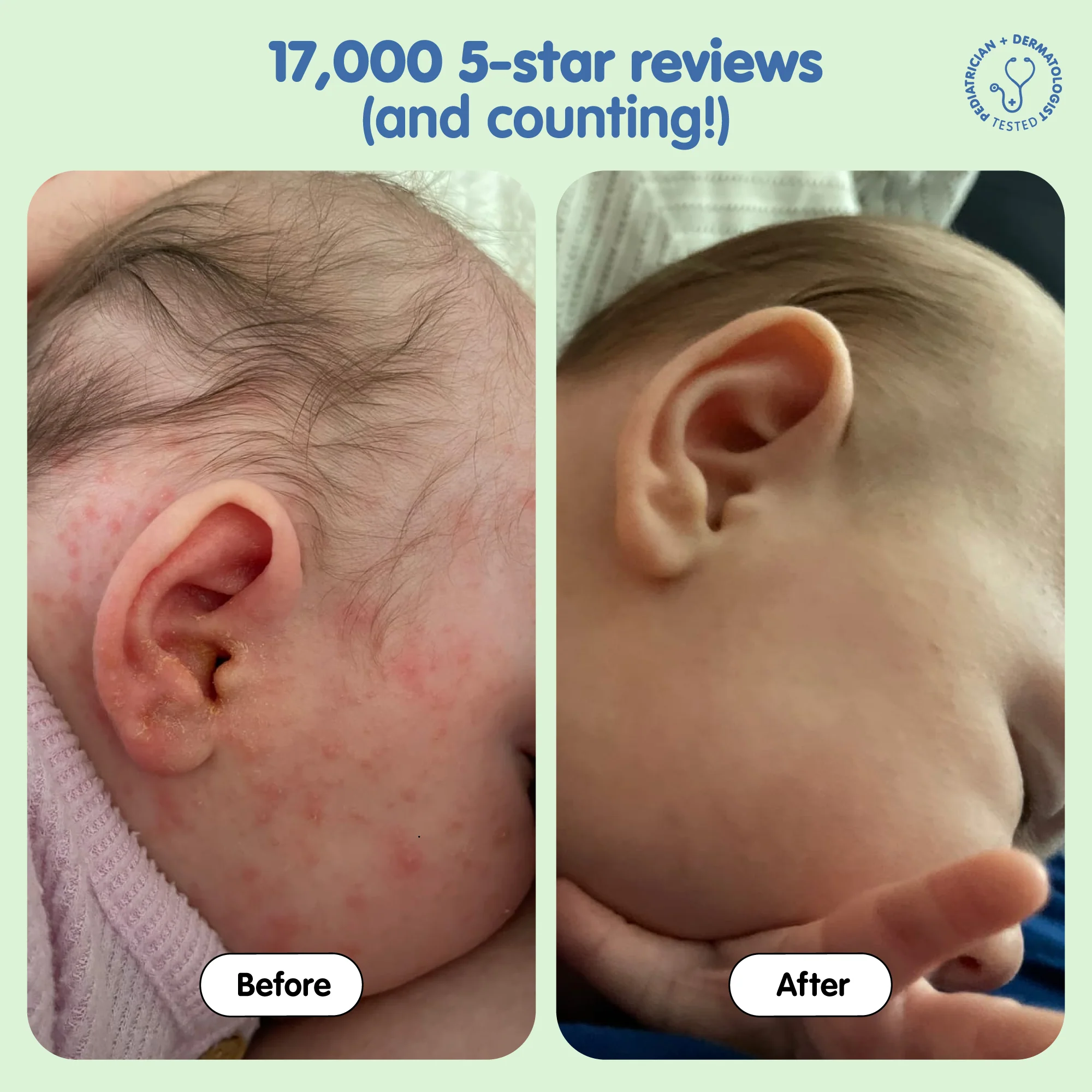 All Over Ointment Eczema Treatment - Image 4